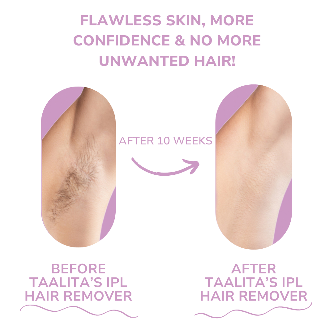 Appareil d'épilation IPL I Épilation laser de référence à domicile