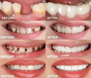 Prothèse dentaire à clipser | Design qui s'appuie sur les dents, sans adhésif | Pour un sourire radieux sans visite chez