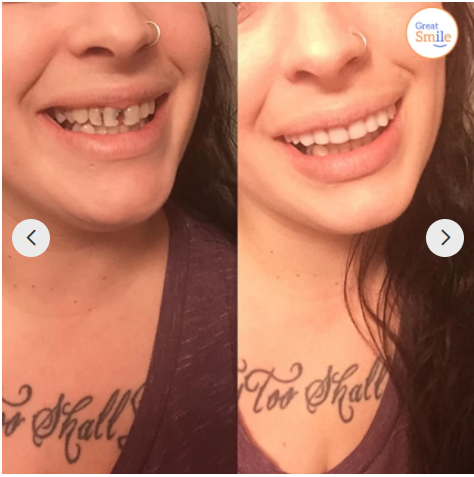 Prothèse dentaire à clipser | Design qui s'appuie sur les dents, sans adhésif | Pour un sourire radieux sans visite chez